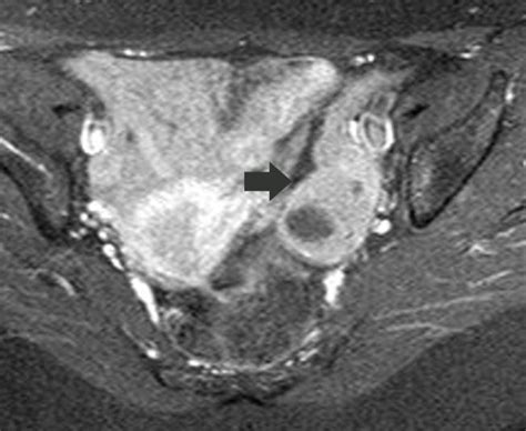 Ovarian Granulosa Cell Tumour Mr Imaging Findings Eurorad