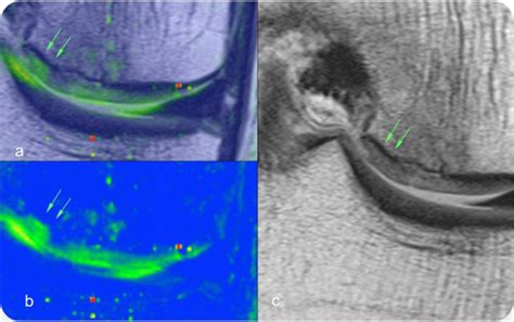 T2 mapping (a & b) shows increase in T2 relaxation value along inner ...