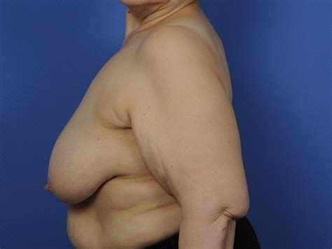 Breast Reconstruction After Lumpectomy Before Afters