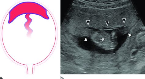 Circumvallate Placenta Symptoms Diagnosis Risks Complications Treatment And Outcomes