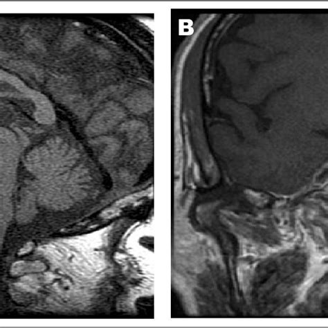 A Precontrast Brain Magnetic Resonance Imaging Mri Demonstrates