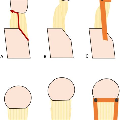 An Ap And Lateral Schematic Demonstrating A Transverse Incision From