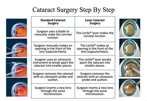 Charleston Cataract Surgery Specialists Ladson Sc Lowcountry Eye Specialists