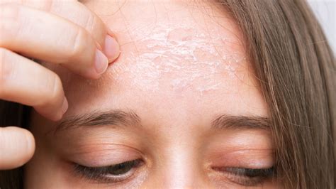 Dry Skin Patches On Face