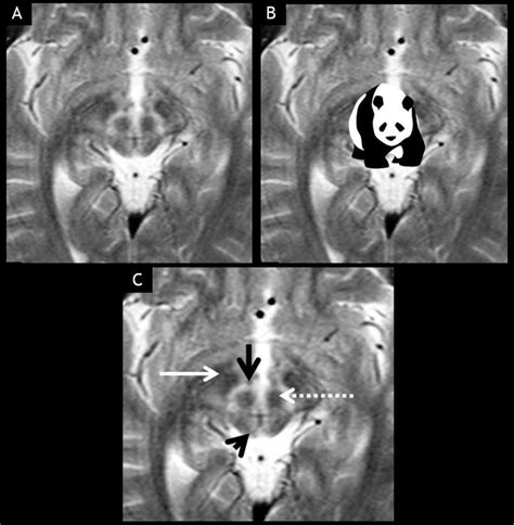 (A, B) Giant panda sign in a young patient of Wilson disease. (C) The ...