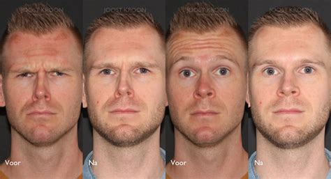 Botox Amsterdam Rimpelbehandeling Met Botox Joost Kroon