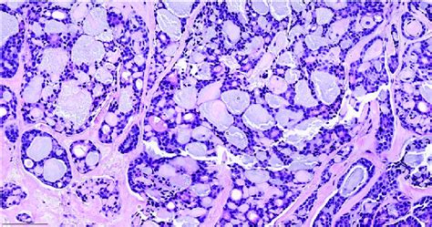 Adenoid Cystic Carcinoma An Example Of Classic Adenoid Cystic Download Scientific Diagram