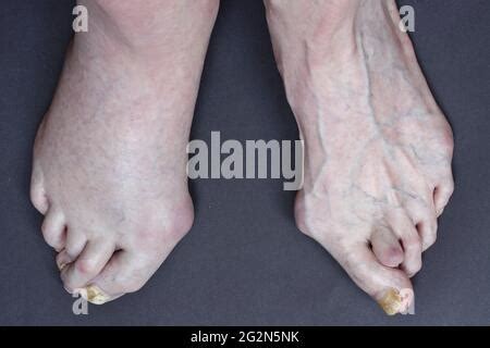 Deformidad Del Pie Humano Hallux Valgus Detalle Fotograf A De Stock