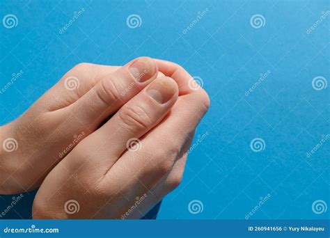 Hands On A Blue Background With Nail Lesions Onycholysis Separation