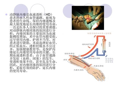 血液透析患者动静脉内瘘闭塞的原因及防护word文档在线阅读与下载无忧文档