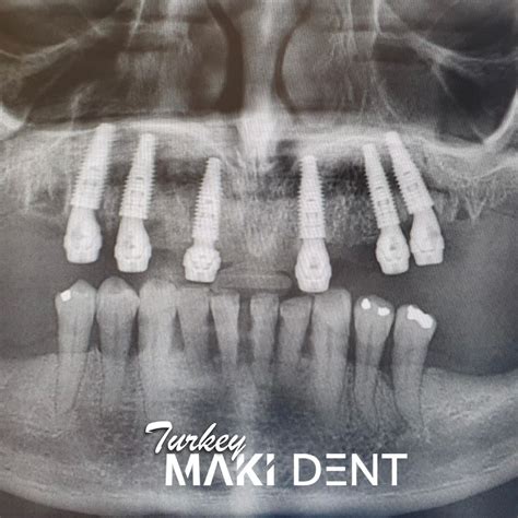 All On 6 Dental Implants Turkey Cost Dental Clinic In Antalya