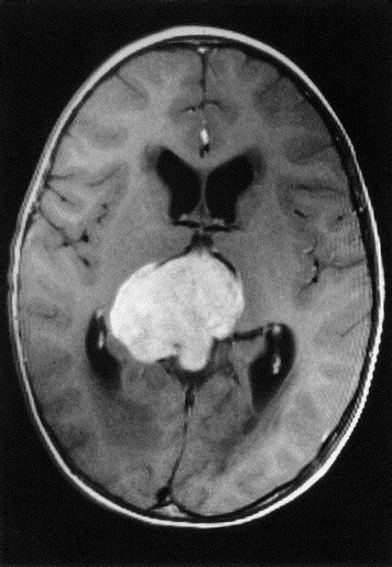 Trilateral Retinoblastoma Survey Of Ophthalmology