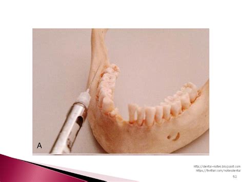 Dental Notes Long Buccal Nerve Block Notes