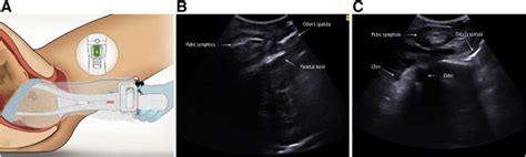 Intrapartum Ultrasound Visualization Of The Odon Device During Operative Vaginal Delivery