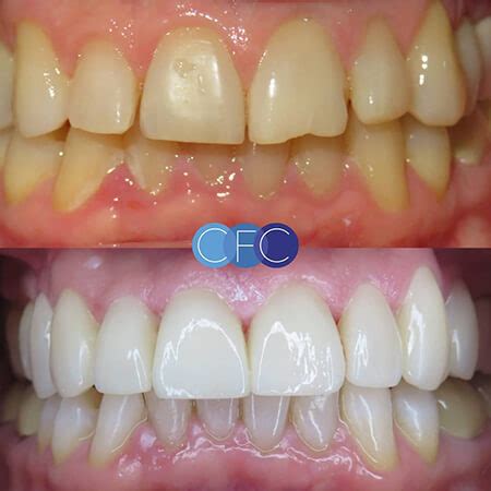 Antes y después blanqueamiento dental de CFC Carlos Fernández De Castro