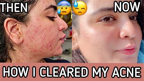 How I Cleared My Skin Pcos Cystic Acne Youtube