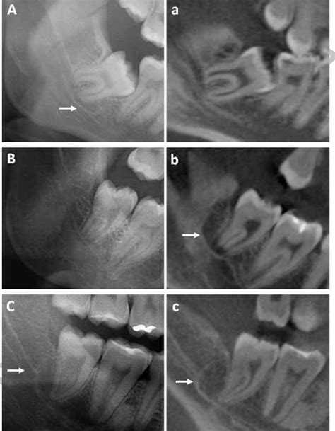 Figure 2 From Comparison Of Panoramic Radiography And Cone Beam Ct In