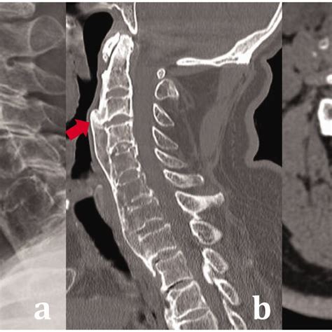 Lateral Cervical Spine Radiographs Obtained On Postoperative Days 1