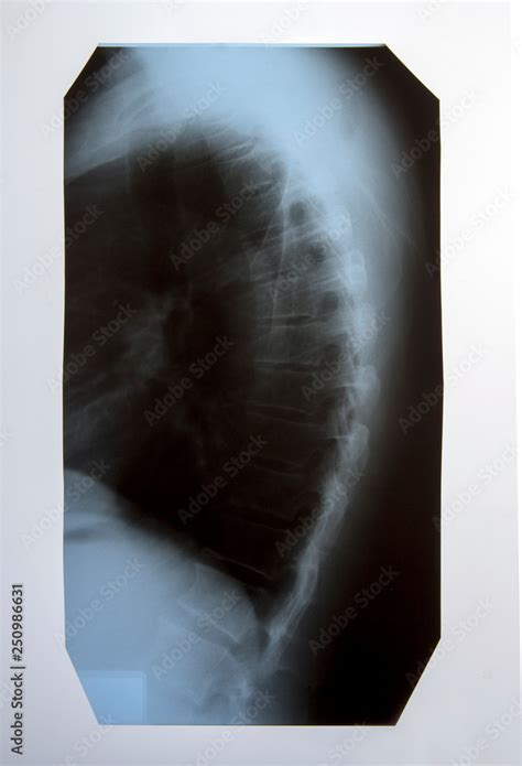 X-ray of the spine and cervical spine Stock Photo | Adobe Stock