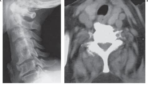 Figure 1 From Dysphagia Caused By Anterior Cervical Osteophytes Semantic Scholar