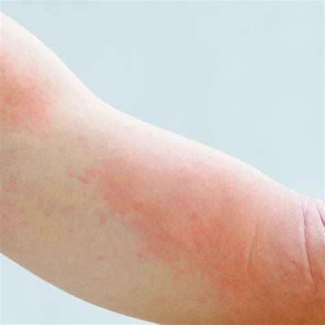 Drug Rashes — Fora Dermatology General And Surgical Dermatology In Mooresville Nc