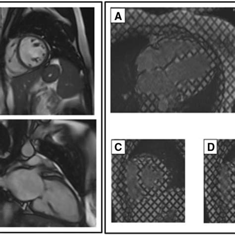 Cardiac Magnetic Resonance Imaging Of One Of Mitral Stenosis Patients