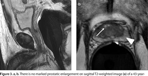 Figure 1 From Magnetic Resonance Imaging Of Benign Prostatic Hyperplasia Semantic Scholar