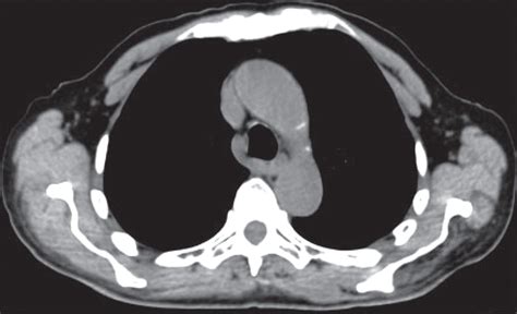 Petct Of Esophageal Cancer Its Role In Clinical Management