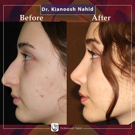 Thin Skin Nose Rhinoplasty Methods And Complications Dr Nahid