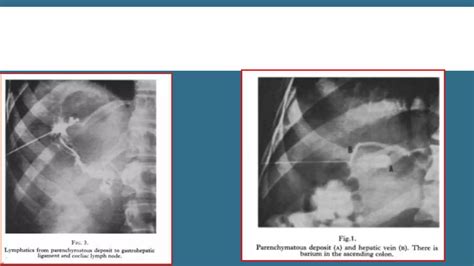 Ptc Percutaneous Transhepatic Cholangiography PPT