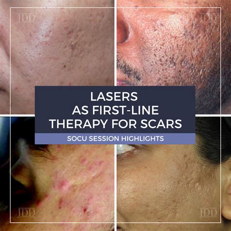 Laser Treatment For Acne Scars What To Expect Cost And 55 OFF