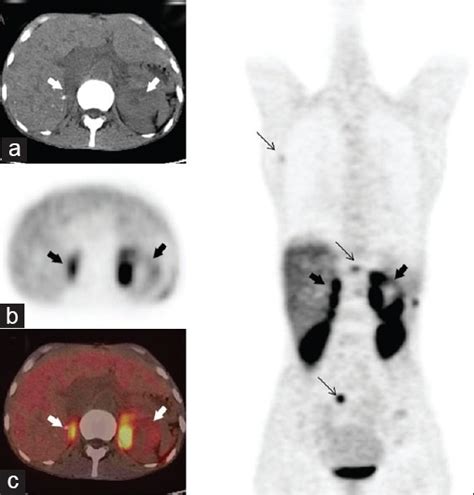 A 28-year-old male with MEN 2 syndrome. CT (a) images reveal bilateral ...