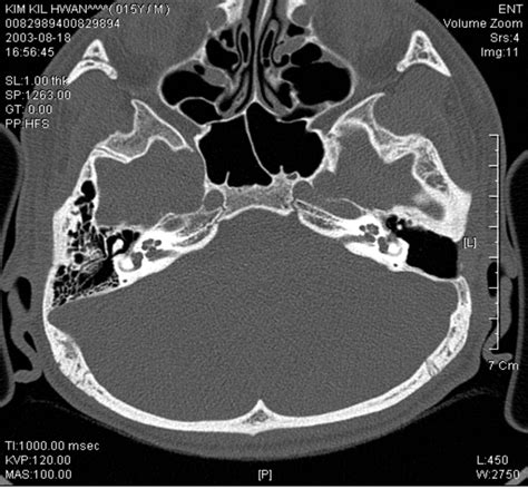 Congenital Cholesteatoma Associated With Blue Eardrum