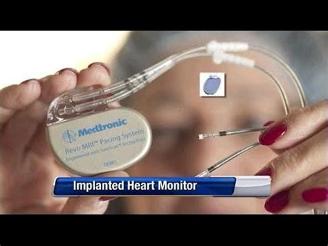 Implanted Heart Monitor Youtube