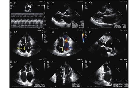 Baseline Two Dimensional Transthoracic Echocardiogram Color Doppler