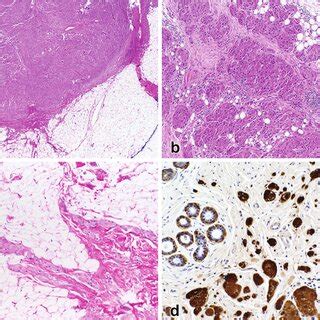 A Well Circumscribed Pattern Of Granular Cell Tumor Of The Breast