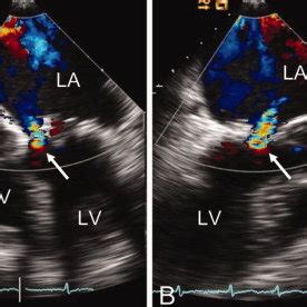 Transesophageal Echocardiography At Mid Esophageal Level In A