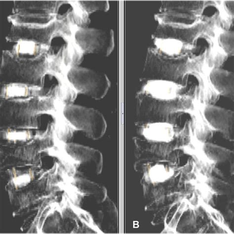 Three Dimensional Reconstructed CT Pre Vs Postinjection Images Image