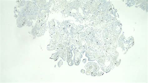 Pathology Outlines Nephrogenic Metaplasia Adenoma