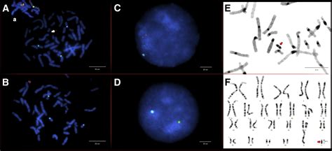 Delineating The Association Between Isodicentric Chromosome Y And Infertility A Retrospective