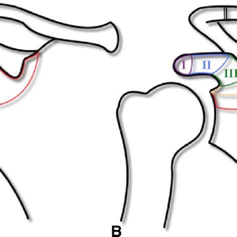 A Eyres Classification Of Coracoid Process Fractures Type I Is A Tip Download Scientific