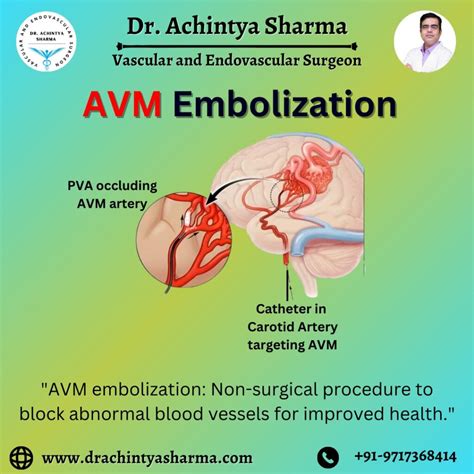 AVM Embolization As A New Treatment Due To Advances