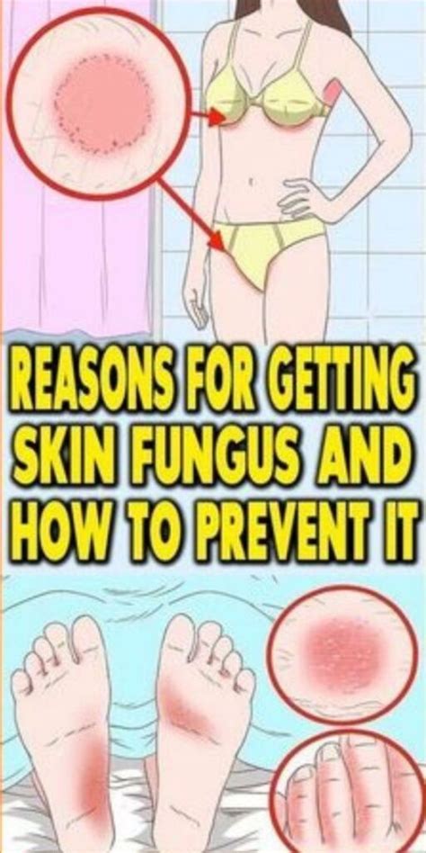 Causes of skin fungus and how to prevent it – Natural Health Care