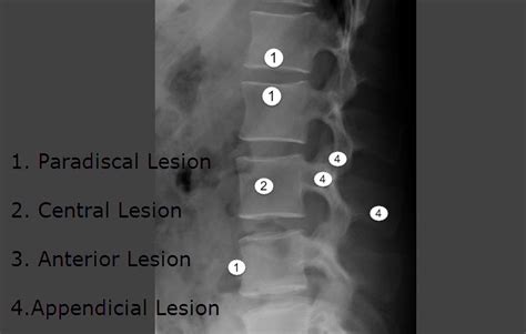 Tuberculosis of Spine Presentation and Treatment | Bone and Spine