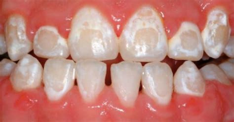 Pictures Of Stained Teeth After Braces Dental News Network