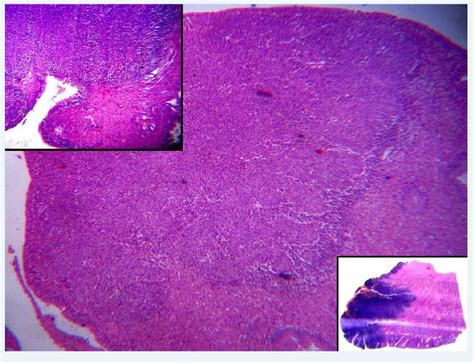 Microscopically Invasive Well Circumscribed Neoplastic Mass Arising