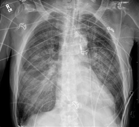 Intra Aortic Balloon Pump Catheter