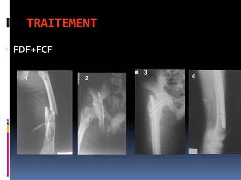 Ppt Fractures De La Diaphyse Femorale Powerpoint Presentation Free