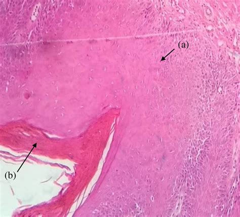 A Acanthosis B Hyperkeratosis H E Moderate Grade Dysplasia