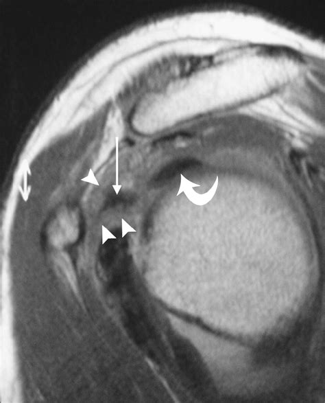 Mri Of The Rotator Interval Of The Shoulder Clinical Radiology